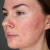 Rosacea a kuperóza (10)